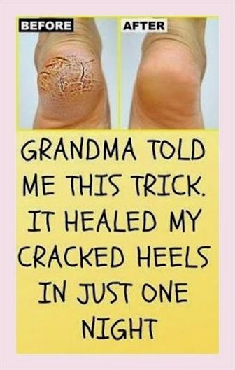 This means a lot to me. Smashing information! Cracked Heel Remedies, Cracked Heels, Brittle Nails, Tooth Decay, About Hair, Insomnia, Home Remedies, Natural Remedies, Healthy Skin