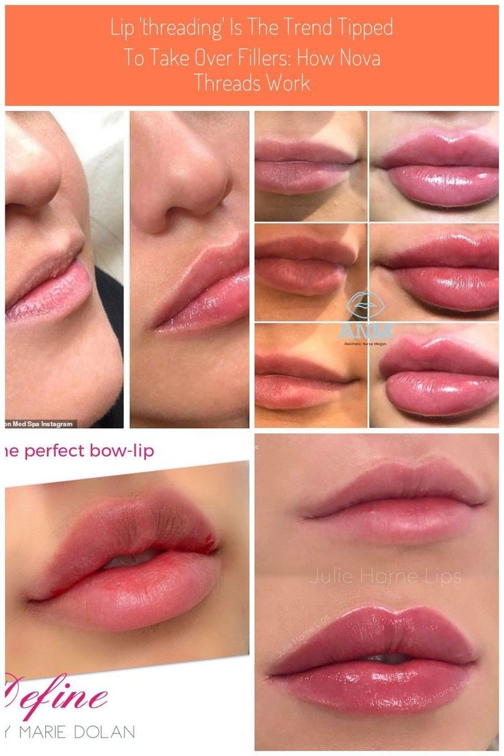 Get Fuller Lips Naturally, Lip Threading, Dermal Fillers Lips, Juvederm Lips, Fuller Lips Naturally, Lips Inspiration, Evening Eye Makeup, Botox Lips, Fuller Lips