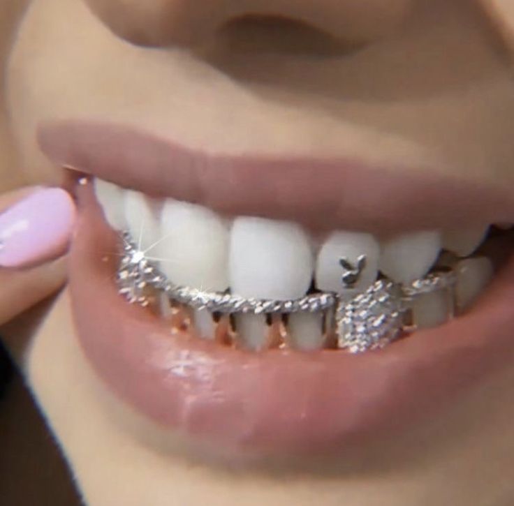 a close up of a person with braces on their teeth and diamond grills