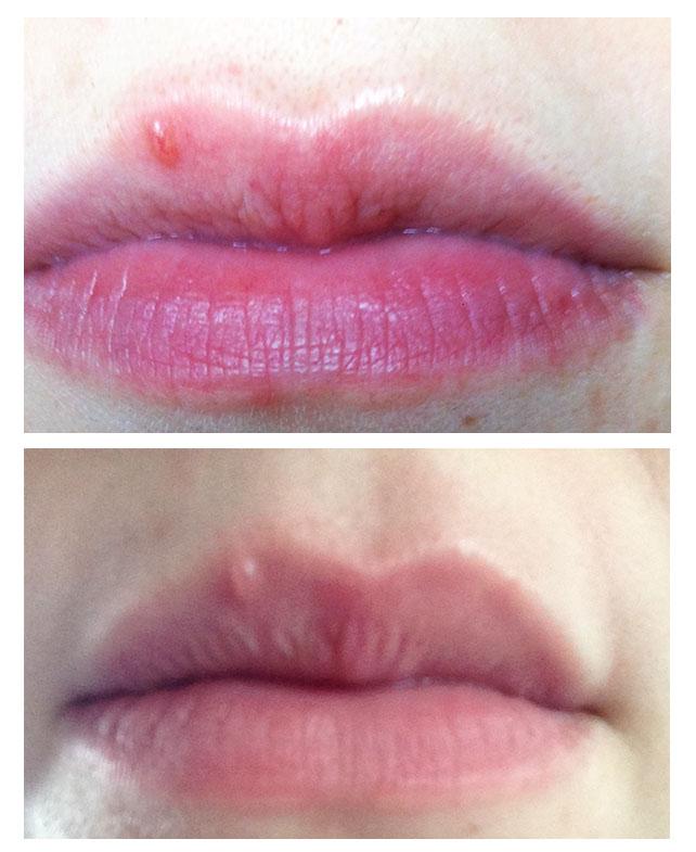 Red Bump On My Lip