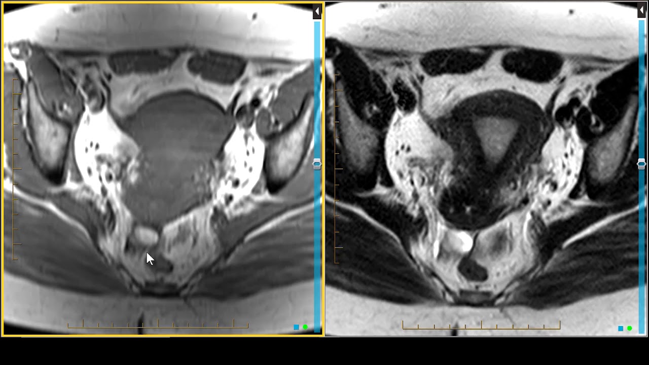 Pelvic Mri Procedure