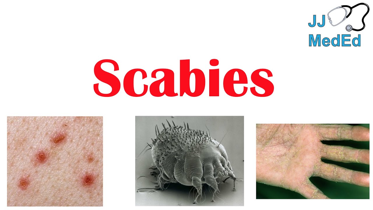 Scabies Mites