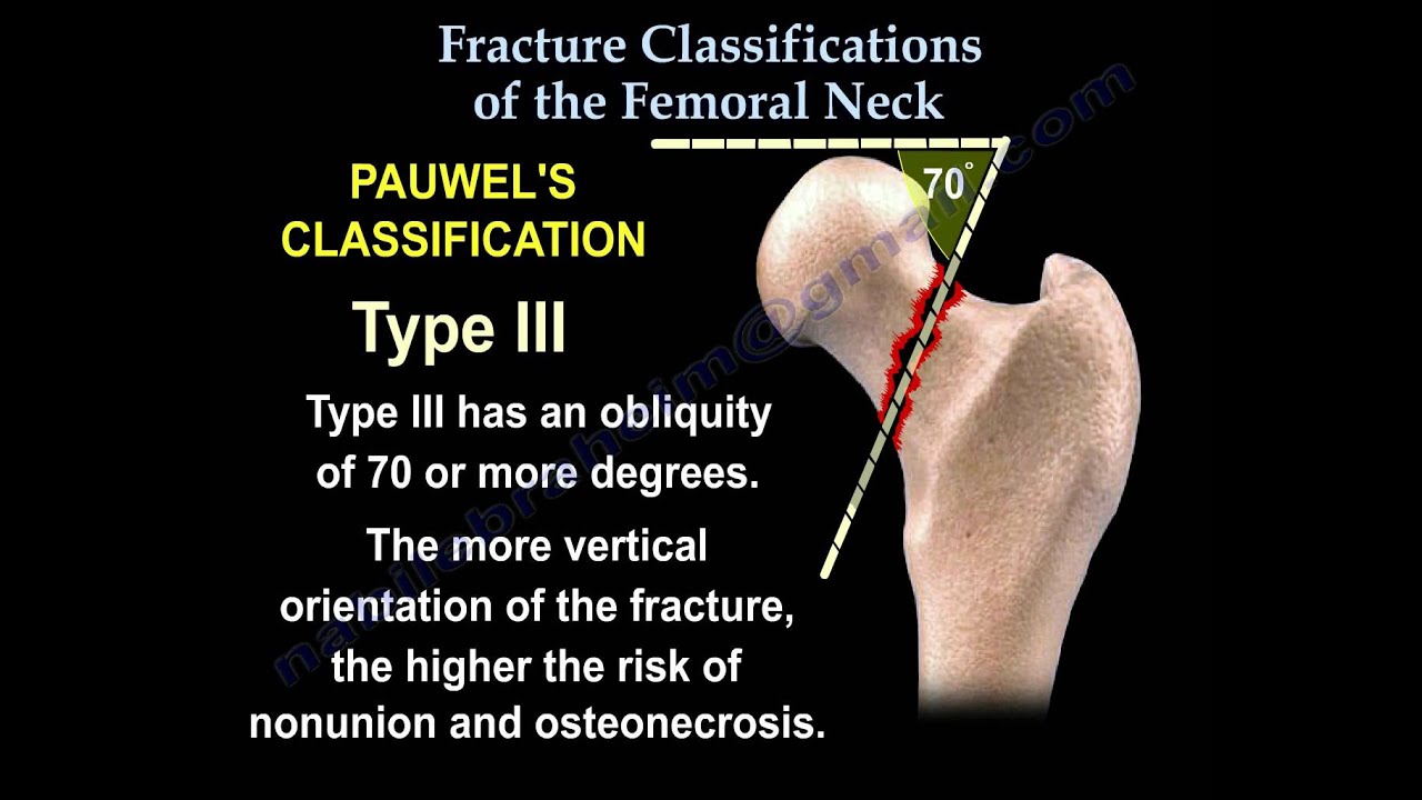 Femoral Neck Fracture