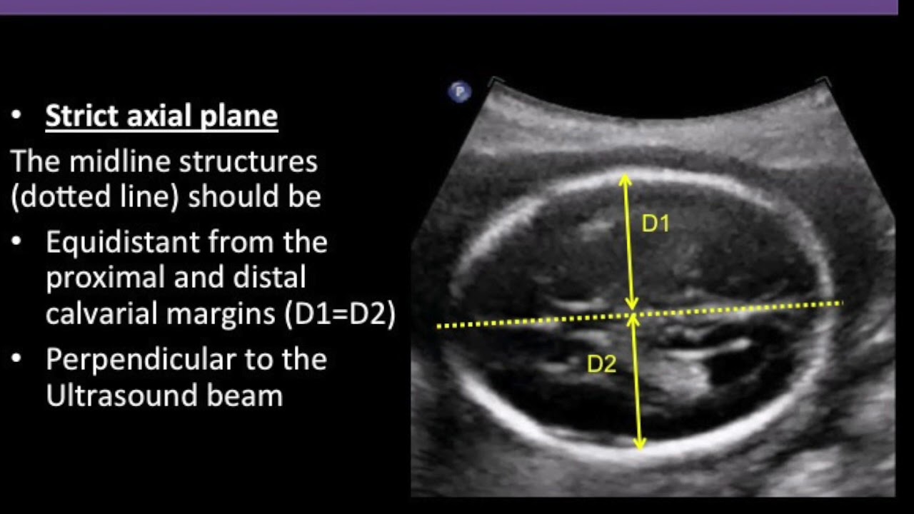 Fetal Hydrocephalus Ultrasound