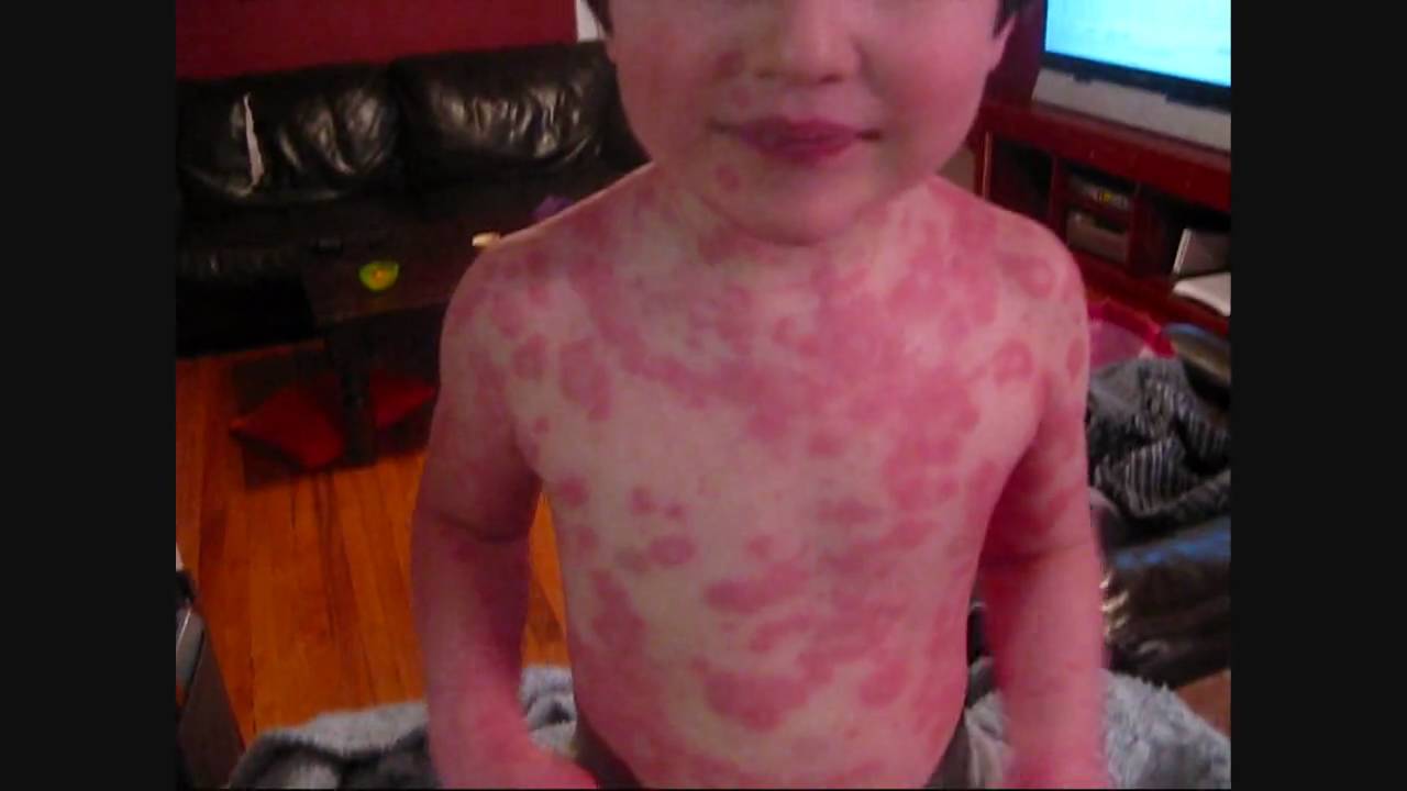 Rash: Get the Facts on Treatment of Various Types of Rashes