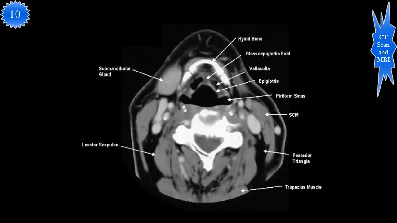 Normal CT Soft Tissue Neck