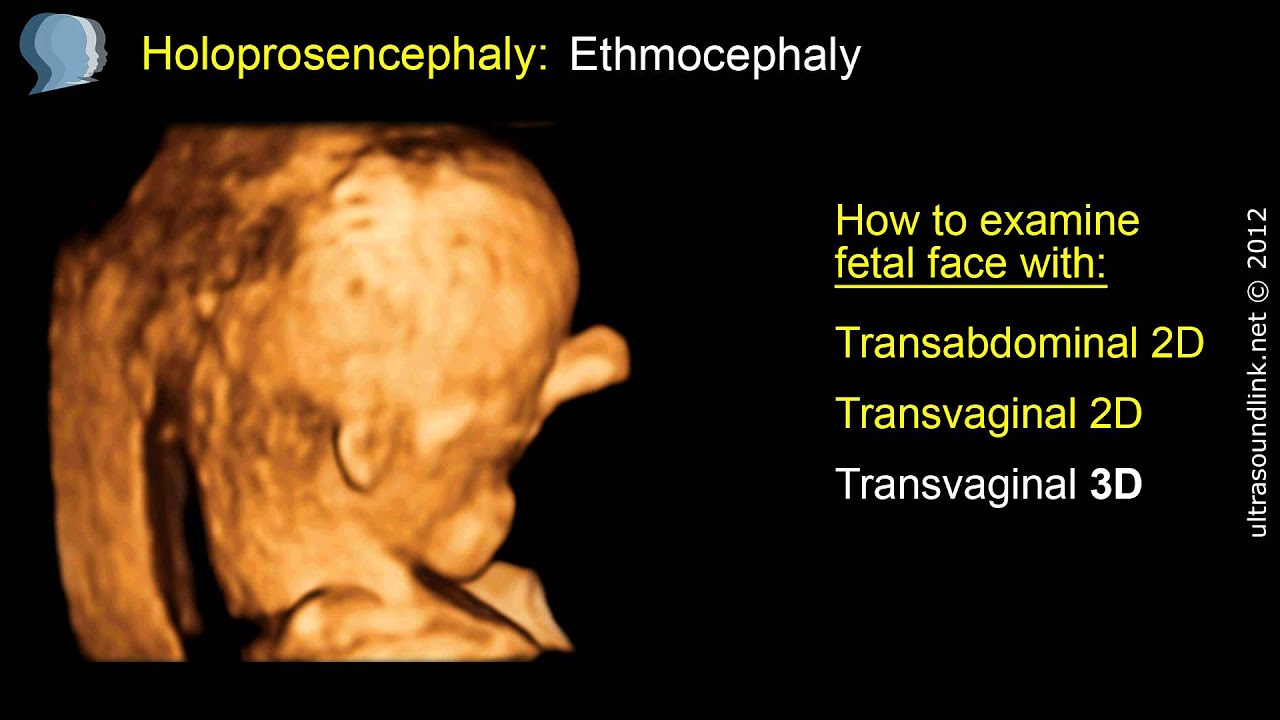 Microphthalmia Ultrasound