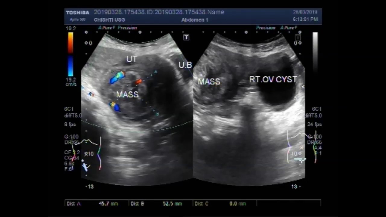 Uterus Fibroids Ultrasound