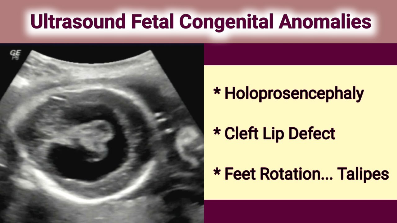 Ultrasound Fetal Holoprosencephaly - YouTube