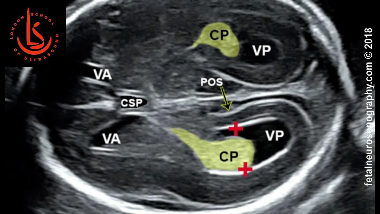 Ventriculomegaly Ultrasound