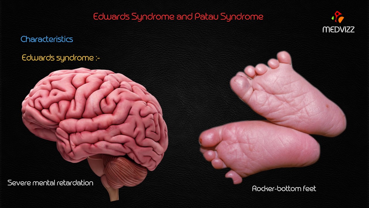 Rocker Bottom Feet Trisomy 18