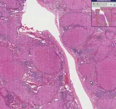 Cirrhosis Histology