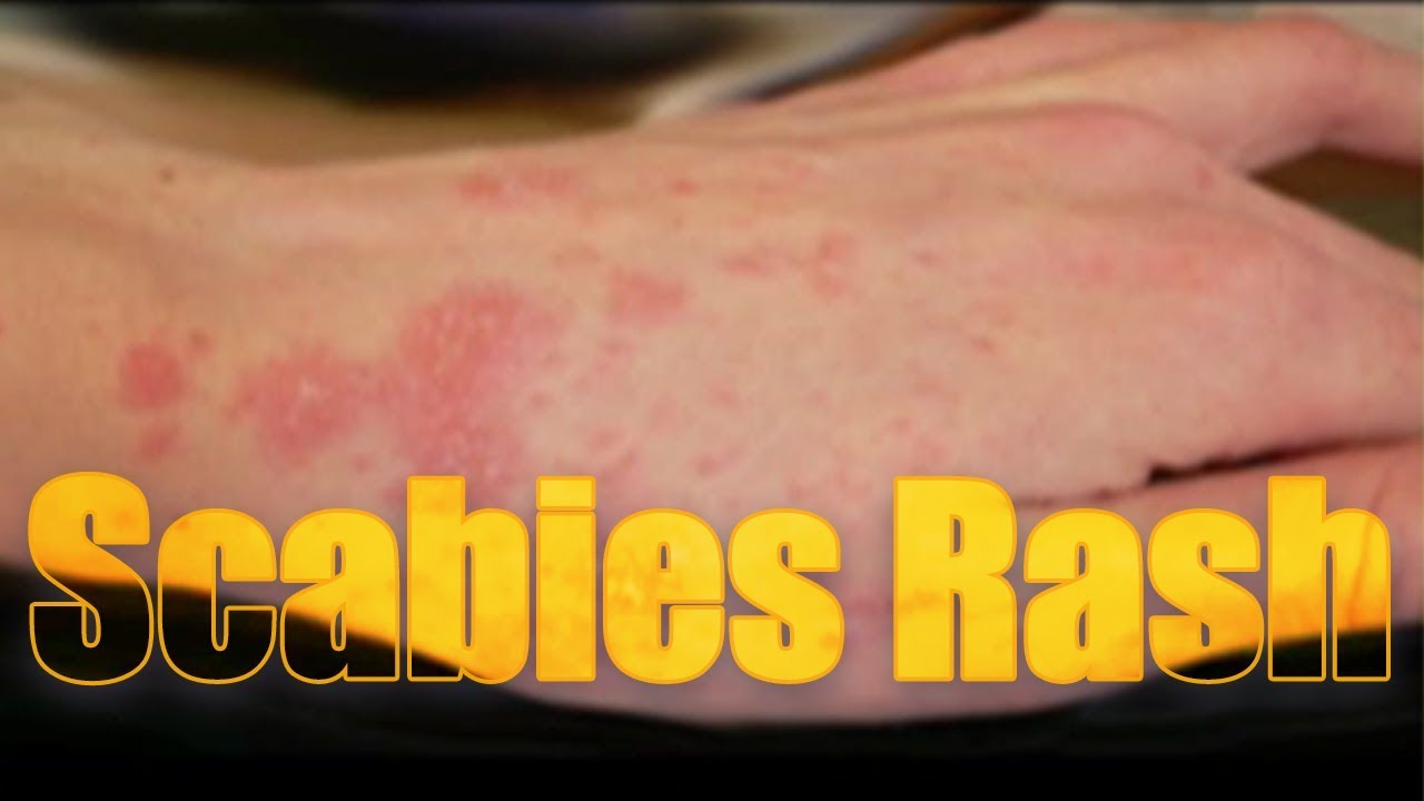 Types of skin rashes that itch and spread - hellokery