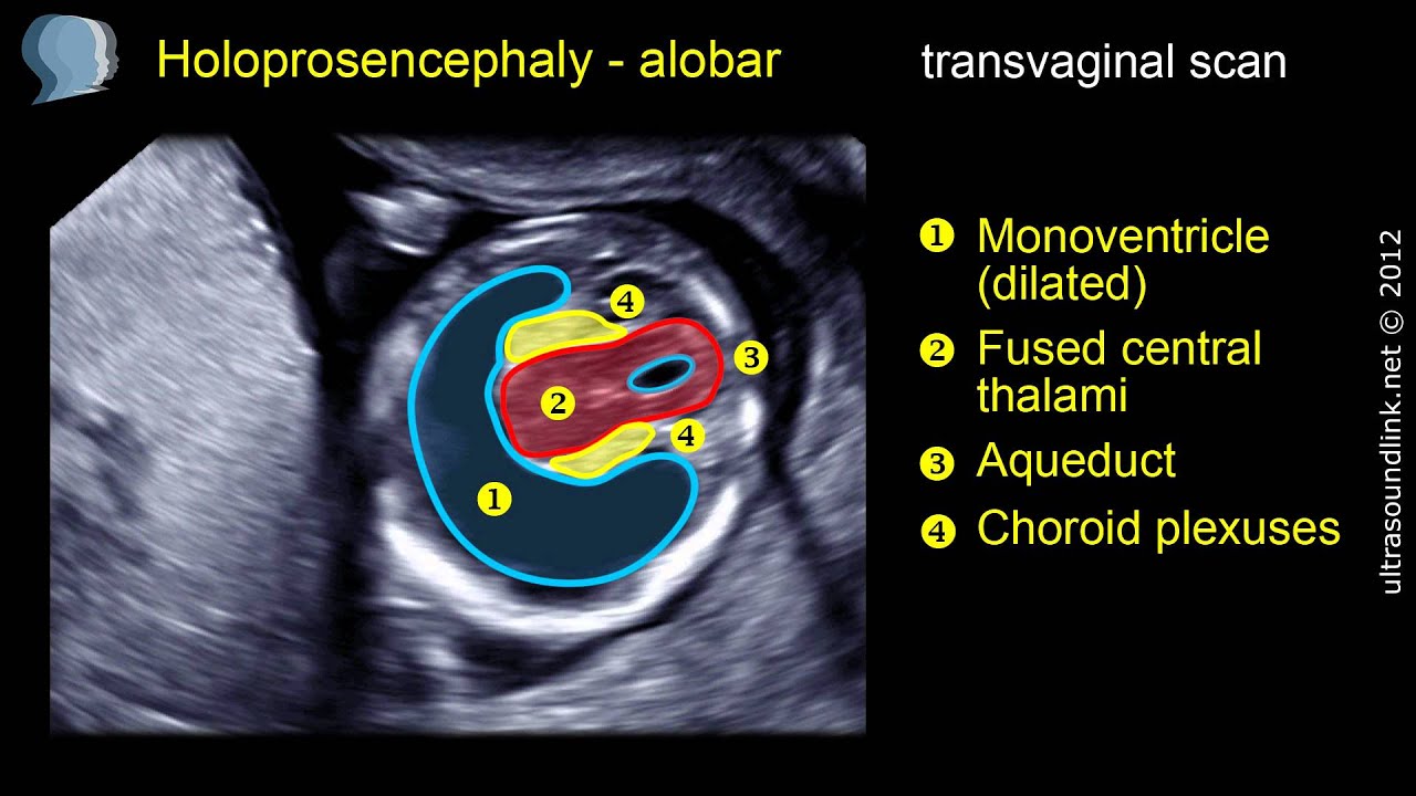 Alobar Holoprosencephaly