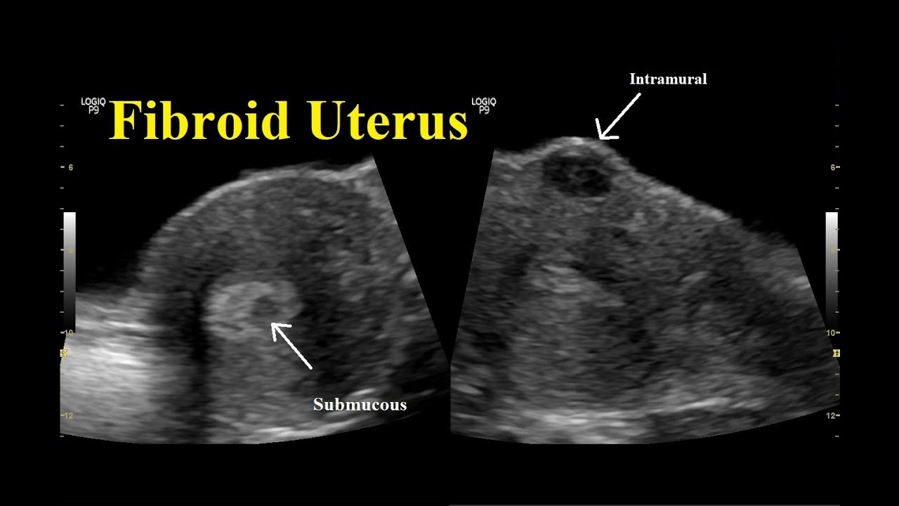 Early Ultrasound Fibroid