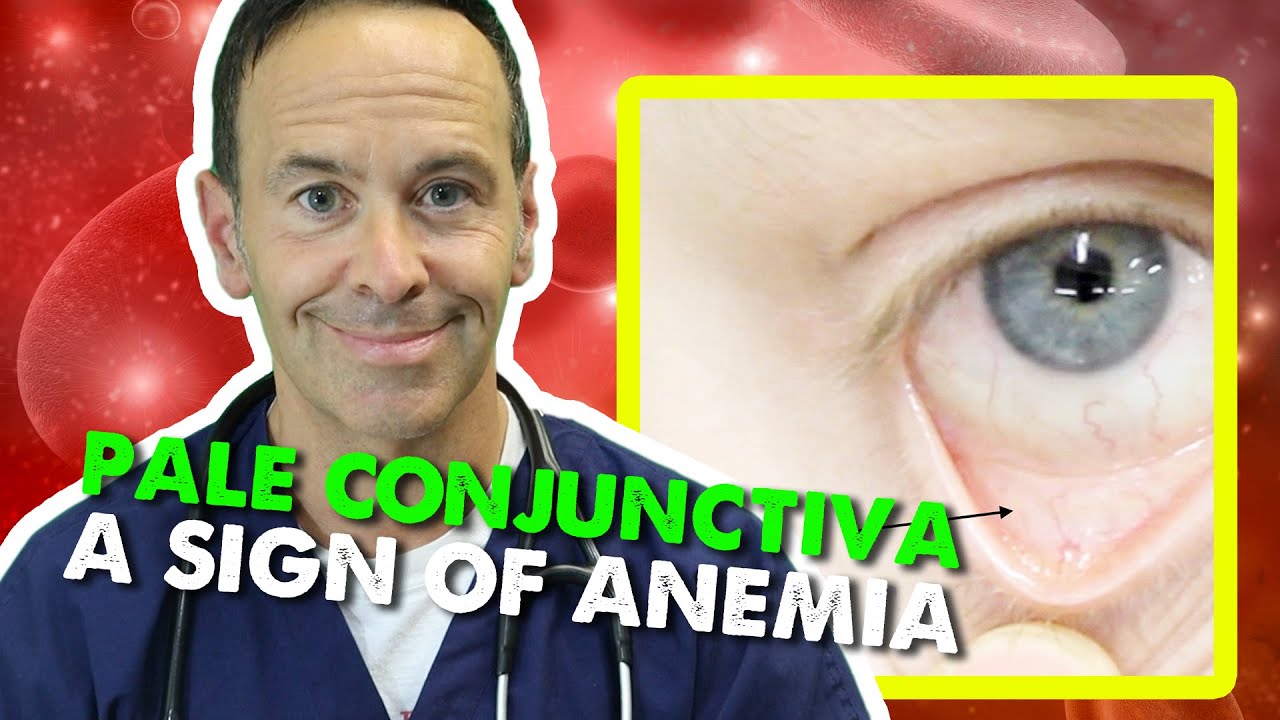 Anemia Eyes