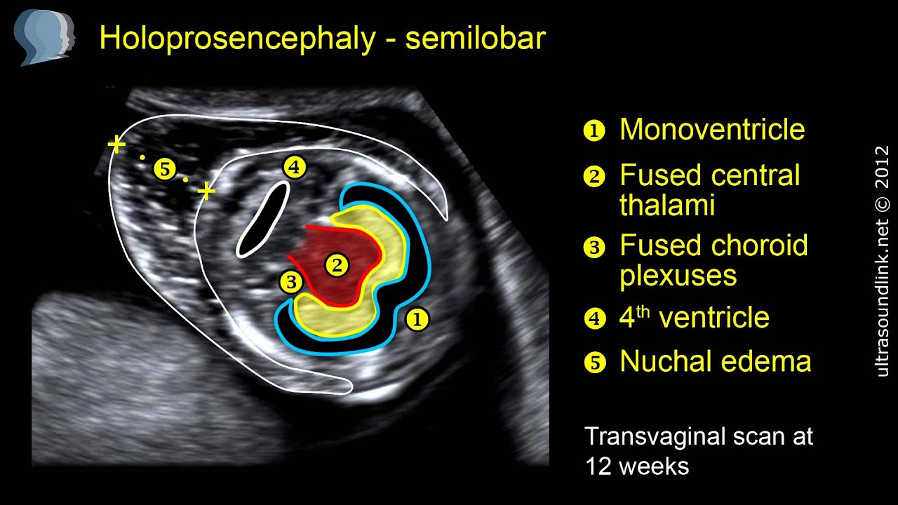 Holoprosencephaly Ultrasound