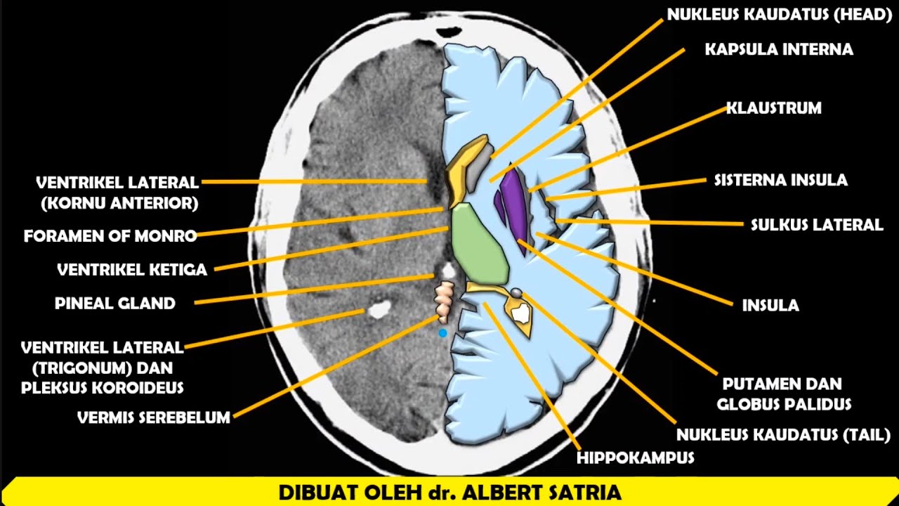 Hug Of Radiology Anatomi Dari Gambaran Ct Scan Kepala - vrogue.co