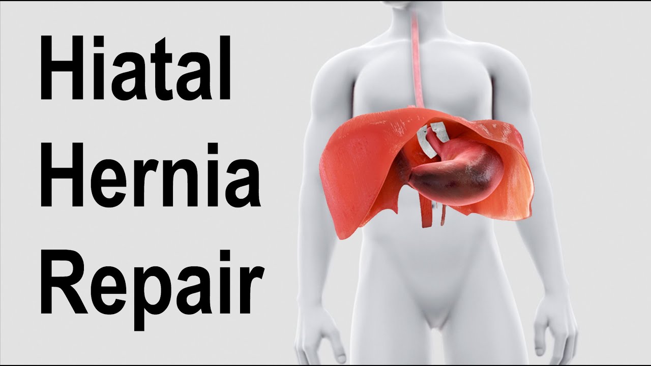 Here’s A Quick Way To Solve A Info About How To Fix Hiatal Hernia ...