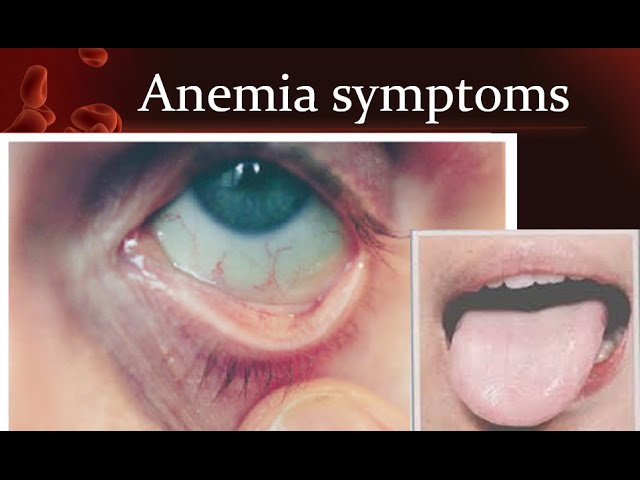 Anemia Eyes