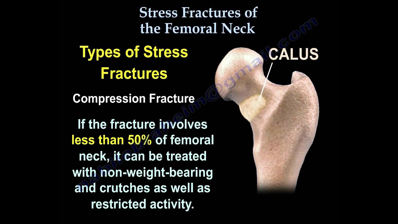 Femoral neck fracture x ray - Derzine