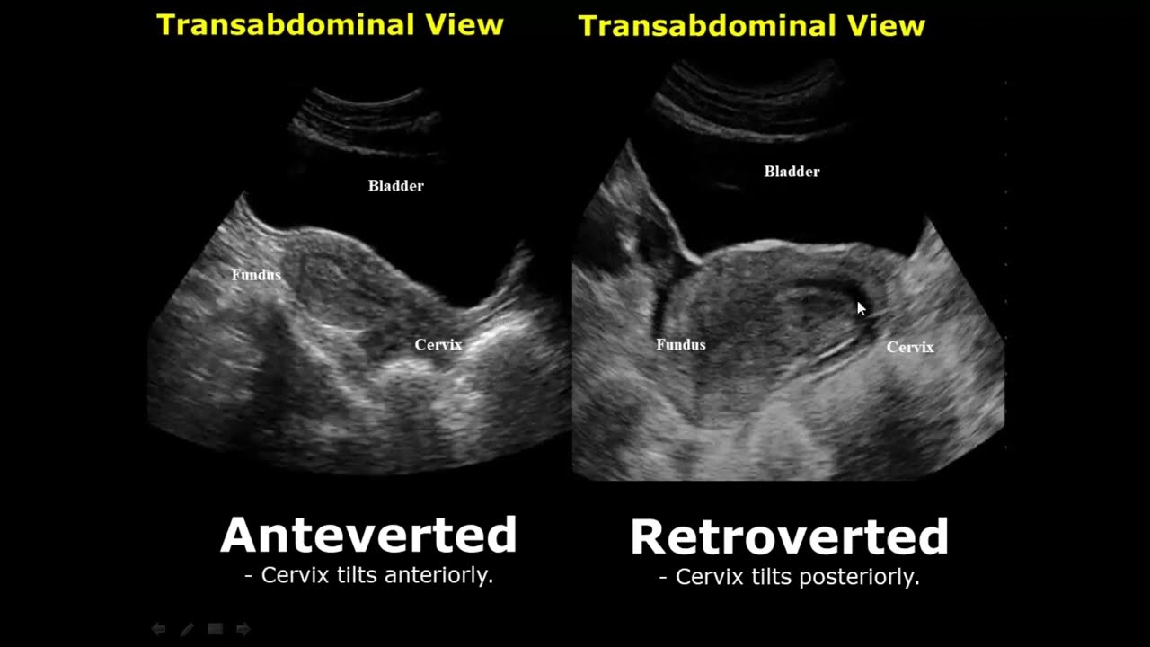 Retroverted Uterus Transabdominal Ultrasound