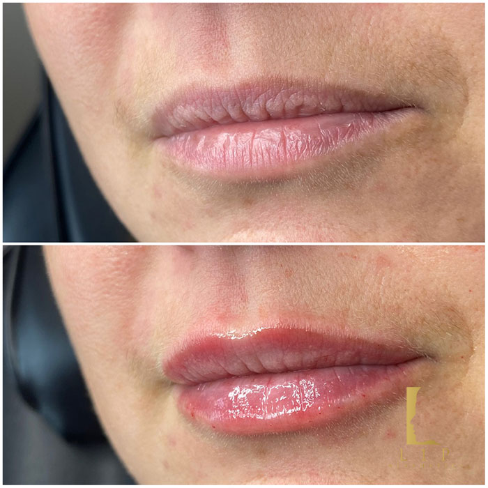 How Much Lip Filler Do I Need? By Dr Ranjbar L1P