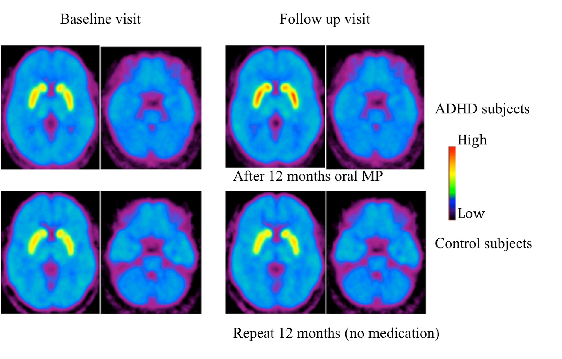 LongTerm ADHD Treatment Increases Brain Dopamine Transporter Levels