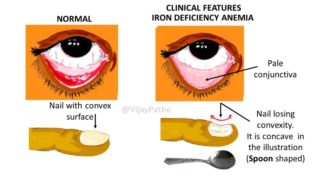 Anemia Eyes