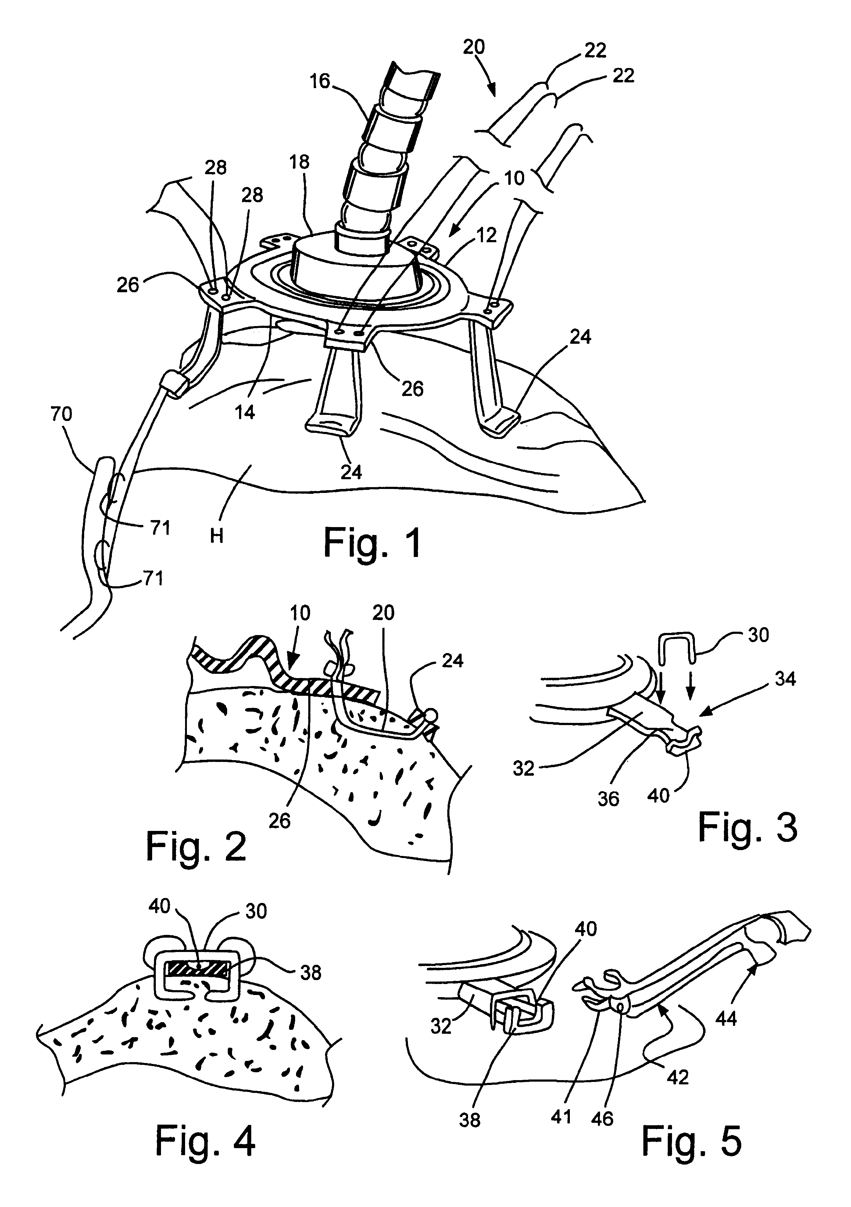 System to permit offpump beating heart coronary bypass surgery