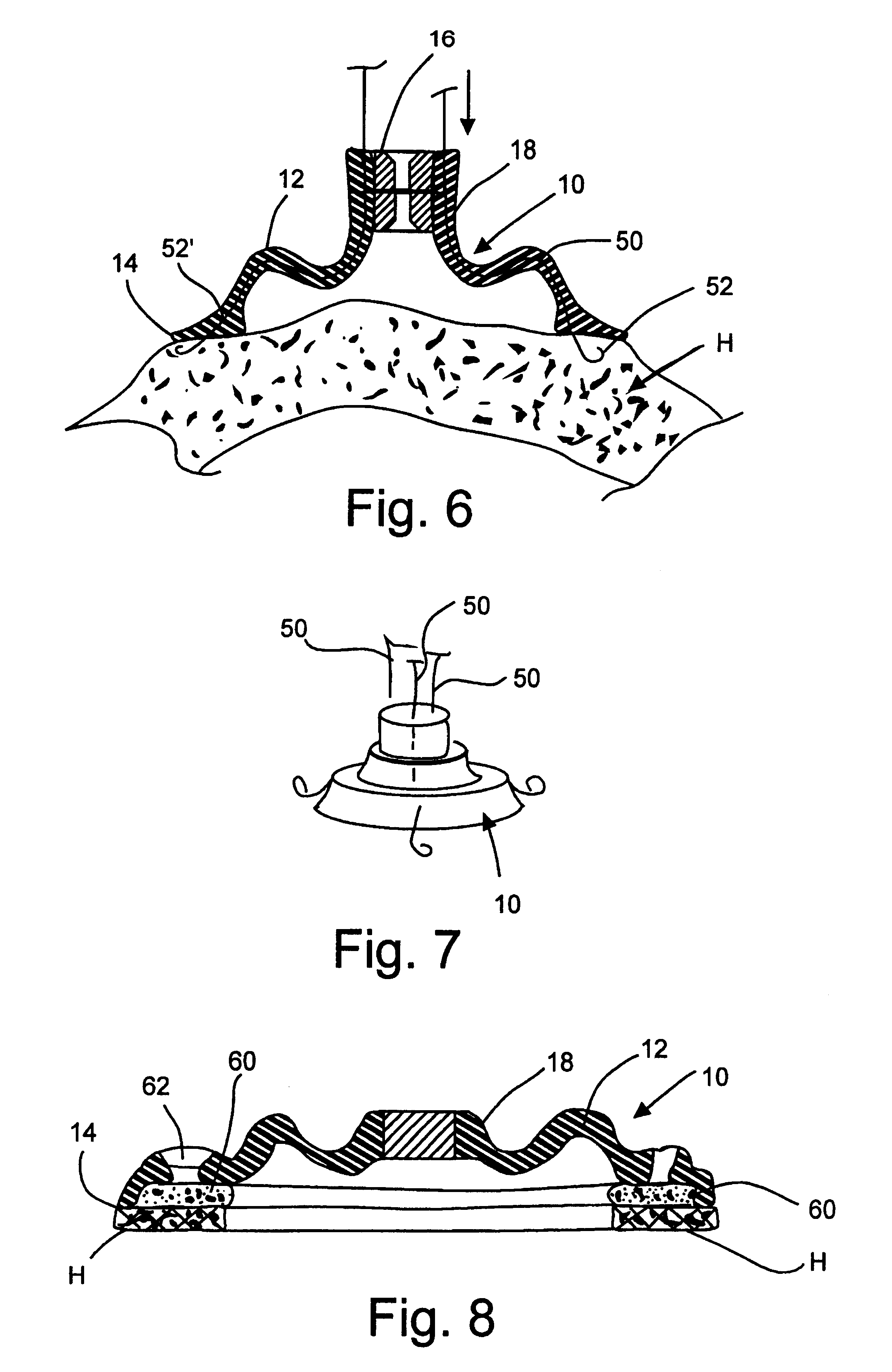 System to permit offpump beating heart coronary bypass surgery