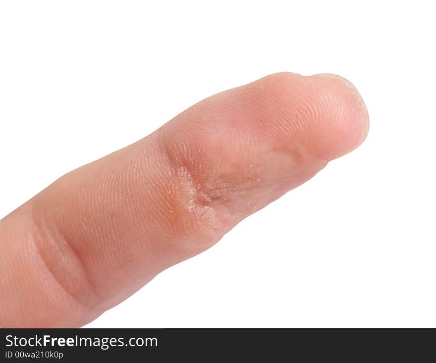 Close up of a finger with an old wound the replaced leather. Close up of a finger with an old wound the replaced leather