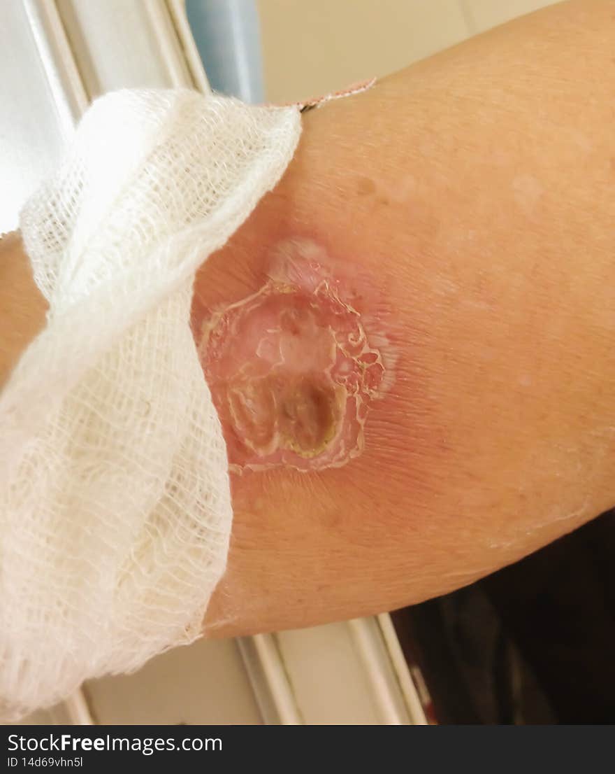 The wound diabetic arm disease and burn wound from hot water, Medical and healthcare concept,background.