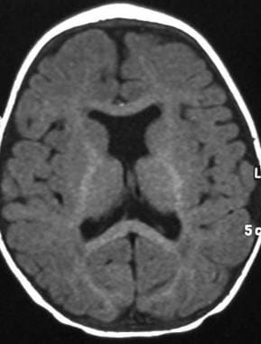 Holoprosencephaly Brain