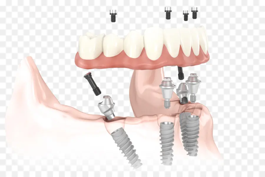 Implantes Dentários，Dentes PNG