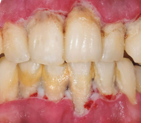 Example image of a mouth with periodontitis gum disease