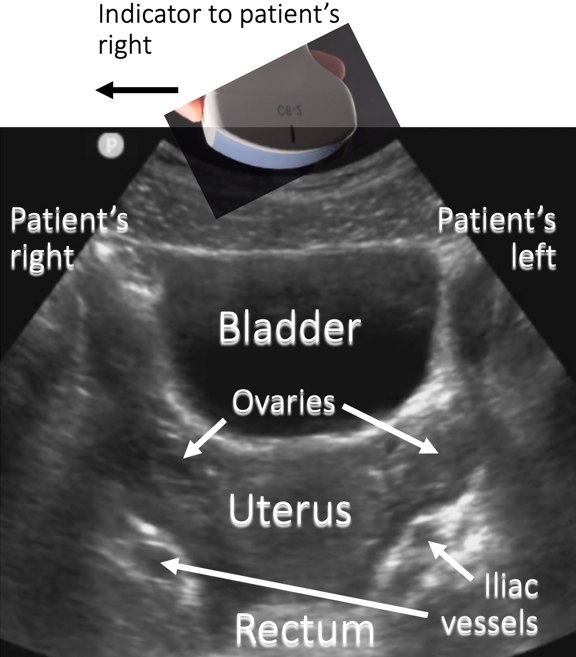 A Sagittal And B Transverse Pelvic Ultrasound Images Sexiz Pix | My XXX ...