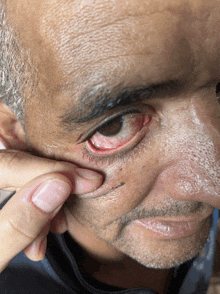 a close up of a man 's face with a red eye and a black spot