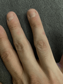 a close up of a person 's hand with their nails missing