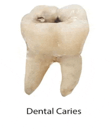 a close up of a tooth with a hole in it and the words `` dental caries '' below it .