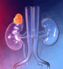 a computer generated image of a kidney with a tumor on it