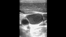 a black and white image of a stomach with a large amount of fluid coming out of it .