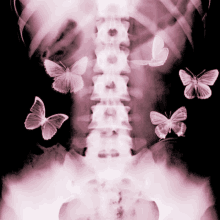 a x-ray of a person 's spine with butterflies flying around it