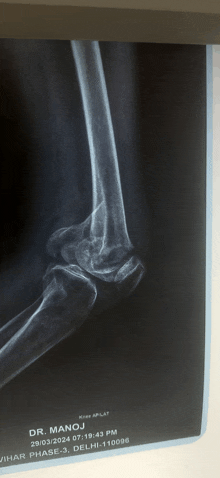 an x-ray of a person 's elbow taken by dr. manoj