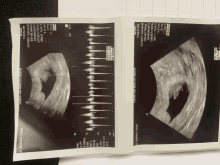 a black and white image of an ultrasound with the date 11/20/2020