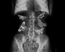 it is an x-ray of a person 's stomach with butterflies on it .