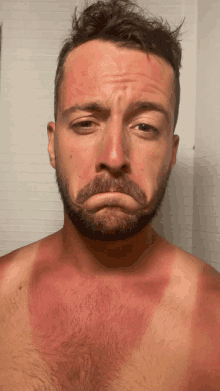 a man with a beard has a sunburned chest