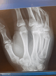 an x-ray of a person 's hand is displayed on a computer monitor