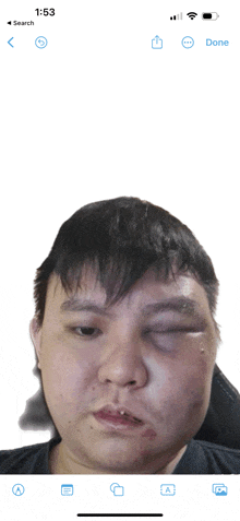 a phone screen shows a man with a black eye and a black shirt