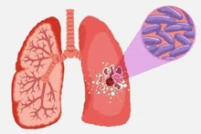 a diagram of a person 's lungs and a picture of a bacteria .